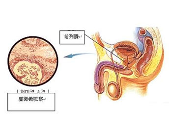 前列腺疾病